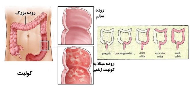 توصیه بهداشتی: تدابیر مربوط به افراد دارای کولیت (Colitis) روده یا روده های تحریک پذیر