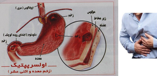 توصیه بهداشتی: رژیم غذایی ناراحتی معده و اثنی عشر