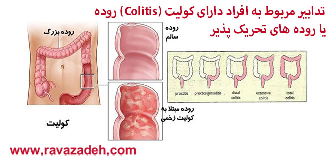 تدابیر مربوط به افراد دارای کولیت (Colitis) روده یا روده های تحریک پذیر