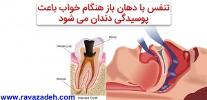 پوسیدگی دندان