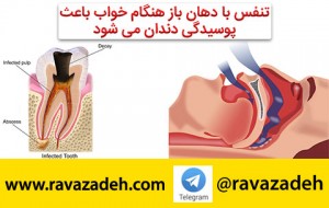 پوسیدگی دندان