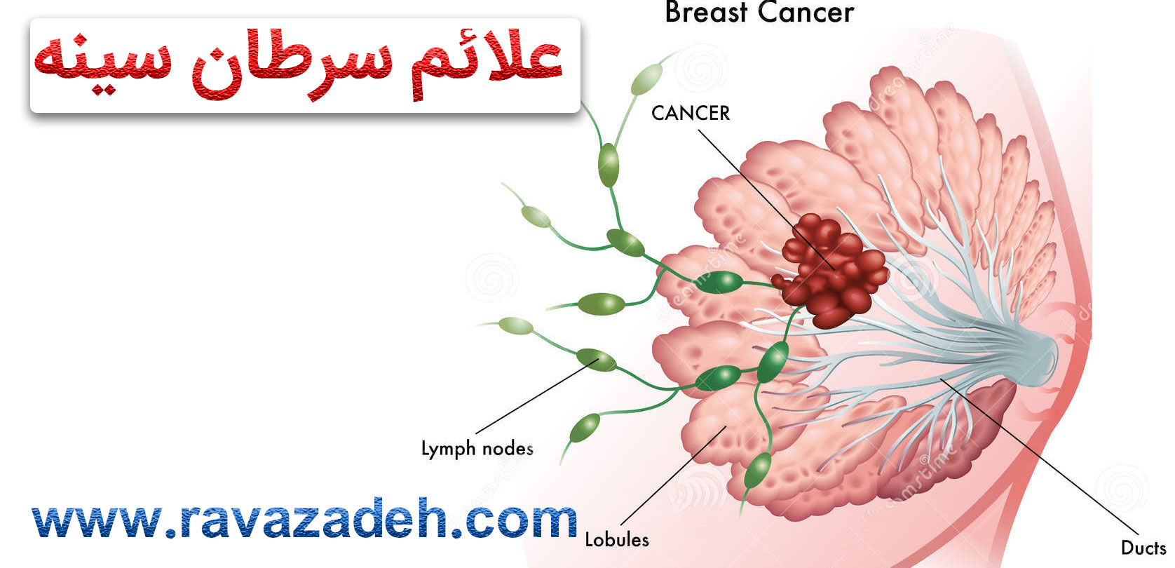 تصویر از علائم سرطان سینه