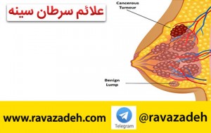 سرطان