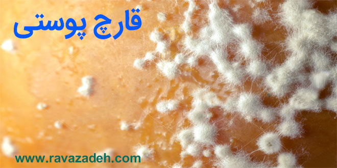 تصویر از توصیه بهداشتی: قارچ پوستی