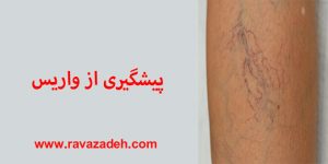 پیشگیری از واریس