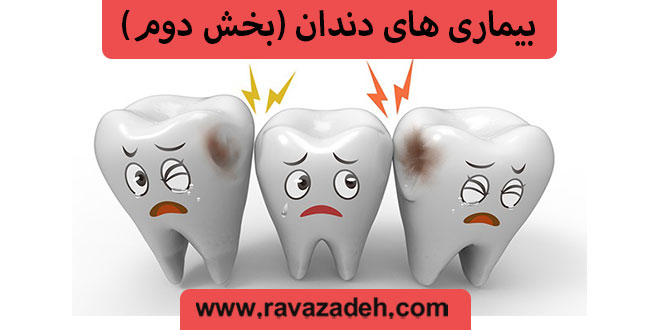 بیماری های دندان (بخش دوم)