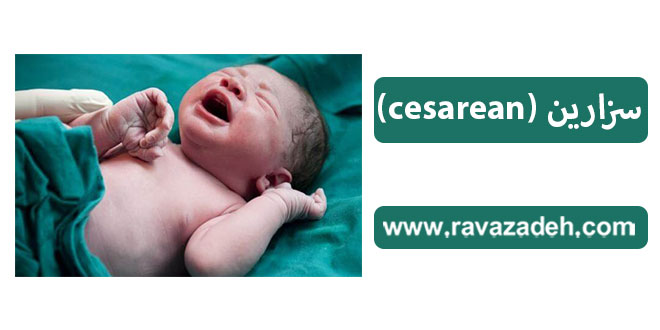 سزارین (cesarean)