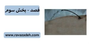 فصد - بخش سوم
