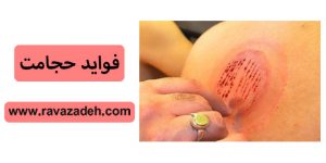 فواید حجامت