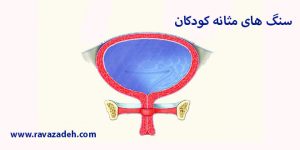 سنگ های مثانه کودکان