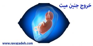 خروج جنین میت 