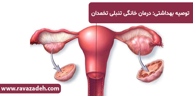 تصویر از توصیه بهداشتی: درمان خانگی تنبلی تخمدان